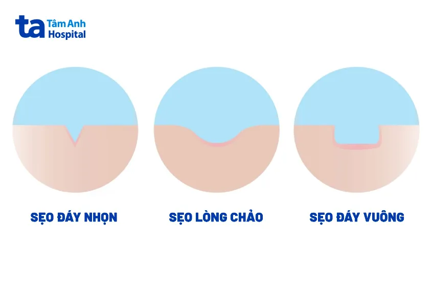 Minh họa các loại sẹo rỗ: đáy nhọn, hình hộp và lòng chảo