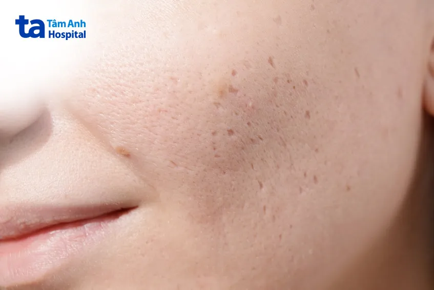 Dung dịch chấm TCA với nhiều nồng độ khác nhau